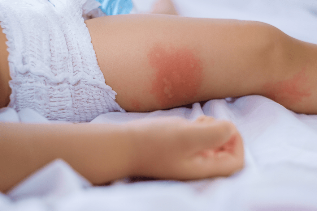 afecciones dermatológicas bebé