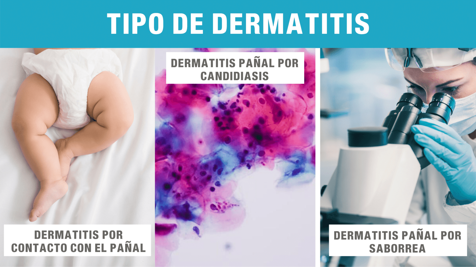 Dermatitis pañal: Síntomas, tipos y causas | Minutus